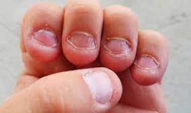 طبيبة روسية تكشف أسباب قضم الأظافر وأقلام الرصاص