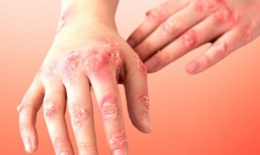 دراسة تكشف أنواع الأطعمة تزيد من خطر الإصابة بالصدفية